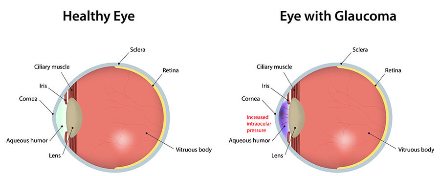 Chart showing a healthy eye, compared to one with glaucoma