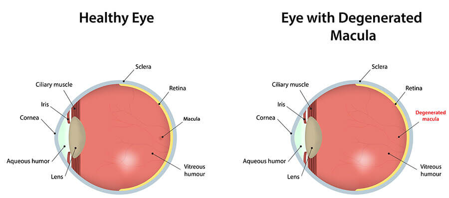 Chart showing a healthy eye, compared to one with macular degeneration